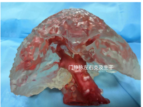 中国首例3D打印精准辅助TIPS穿刺手术